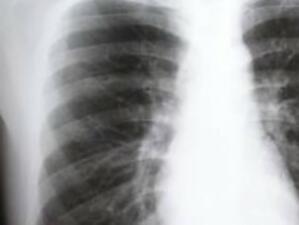  България получава над 9 млн. евро за борба с туберкулозата